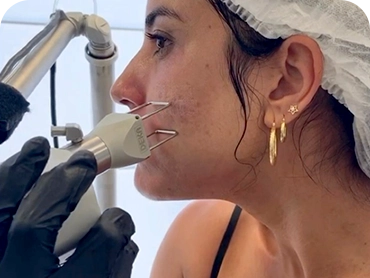 Laser CO2 Fracinado e rejuvenescimento