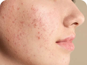 Tratamento de acne e cicatriz de acne