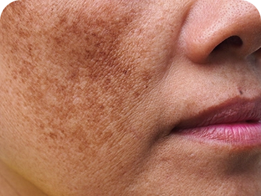 Tratamento de melasma